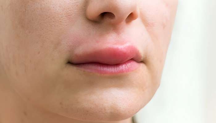 Çocuklarda Dudak Şişmesi