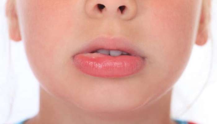 cocuklarda-dudak-sismesi
