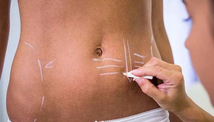 Cilt Çatlakları Lazer Tedavisi